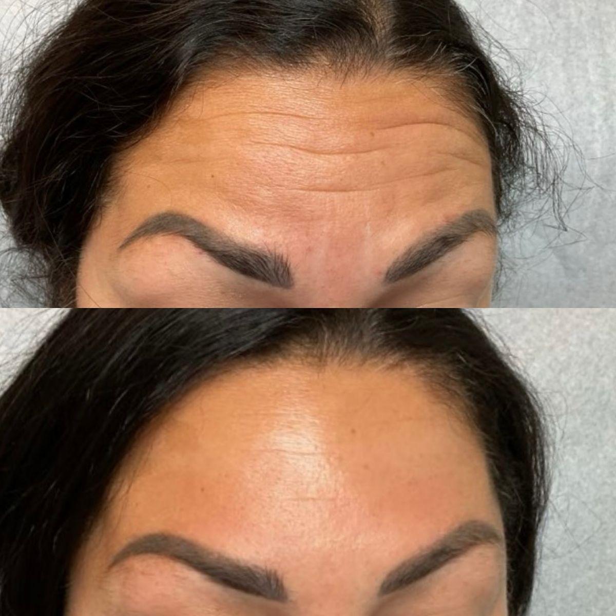 Botox